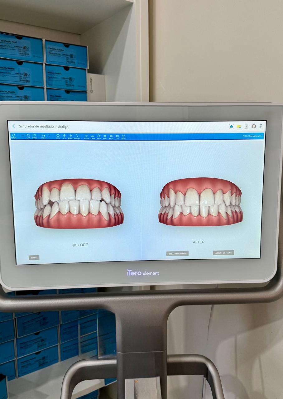 Tela do scanner iTero exibindo simulação digital before e after do sorriso