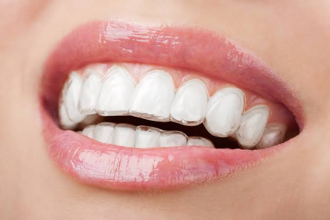 Sorriso usando alinhadores transparentes